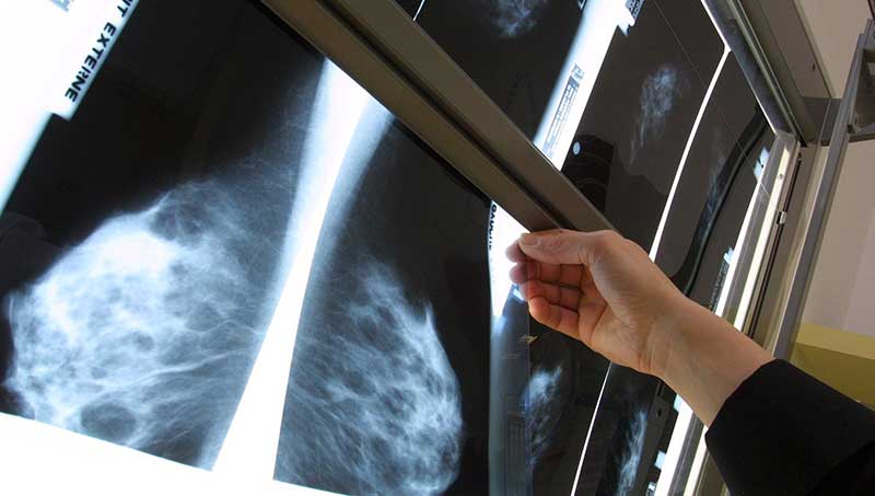 Kvinnor över 74 kan erbjudas mammografi