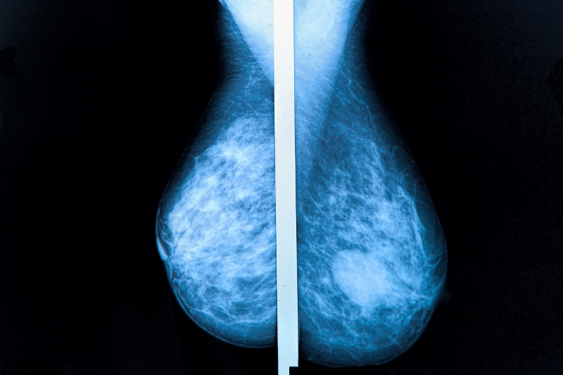 Kritiken växer mot åldersgräns för mammografi